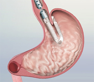 Colorectal Cancer Screening and Surveillance